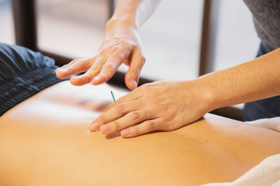 A close-up of an acupuncture needle being placed in a patient's lower back during a fertility acupuncture session, one of the natural treatments used to enhance male and female fertility at Willow Tree Clinic.