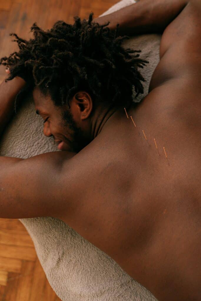 a person laying down on their stomach with acupuncture needles in their upper back