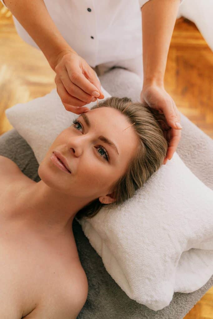 a woman laying down getting acupuncture for migraines