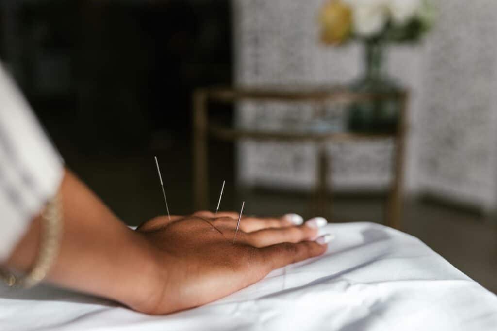 Woman receiving acupuncture for TMJ