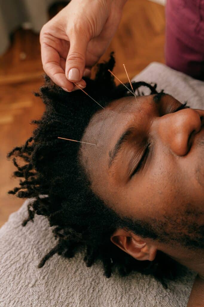 man getting acupuncture needles in forehead