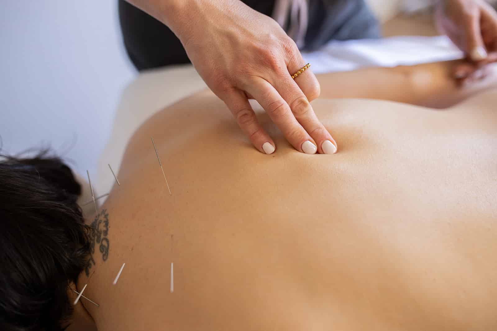 Close-up of acupuncture needles placed along a patient’s upper back as a licensed acupuncturist gently palpates the area during a treatment session at Willow Tree Clinic in Portland.