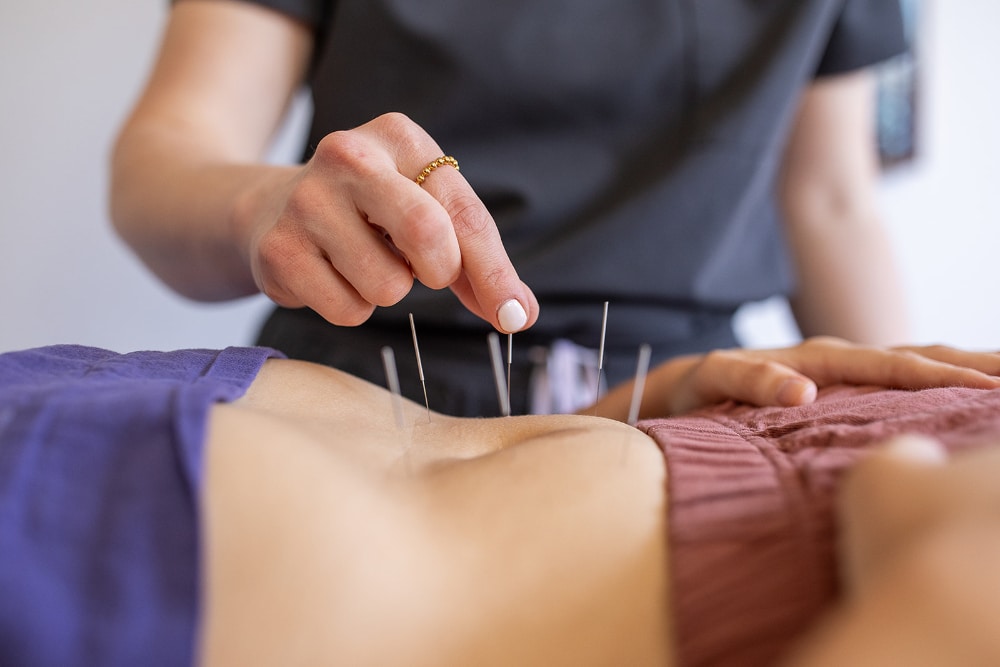 Close-up of acupuncture needles placed on the abdomen during a fertility treatment session, commonly used in fertility success stories