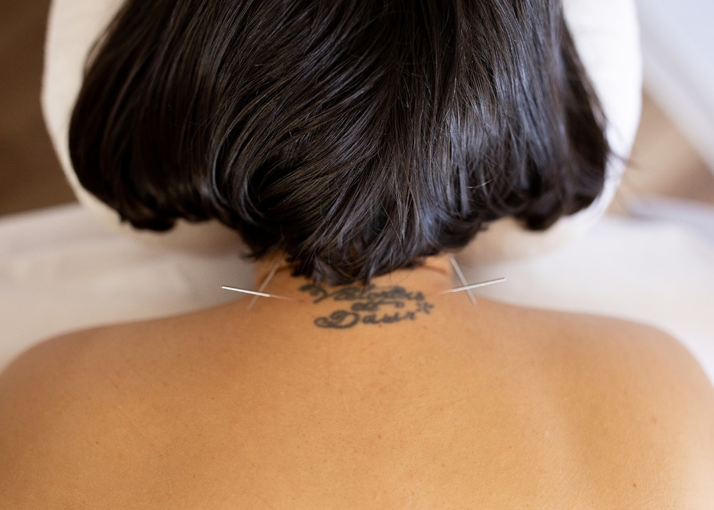 Acupuncture needles placed along the upper back and neck, supporting nervous system regulation often seen in fertility success stories