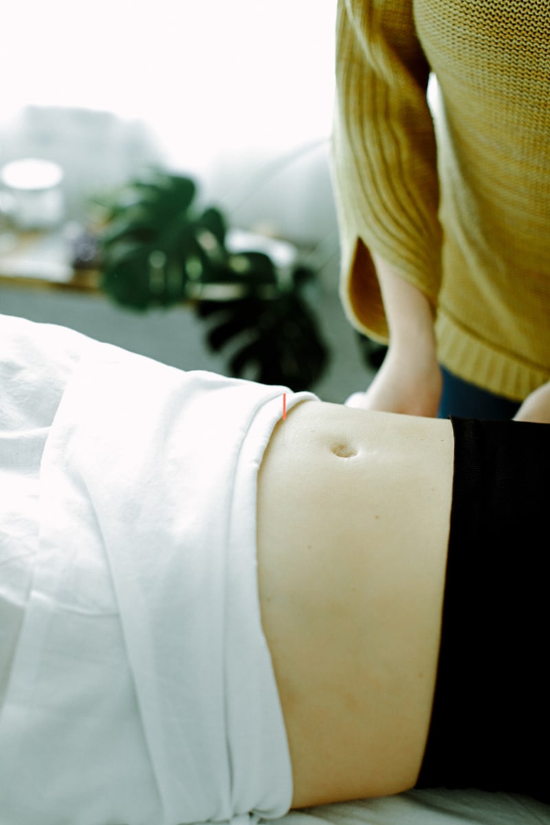 Close-up of acupuncture needle placed in the lower abdomen during a fertility treatment, showing targeted support for uterine blood flow often used before embryo transfer in Portland acupuncture sessions.